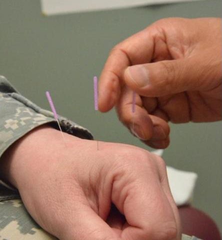 Acupuntura para el dolor